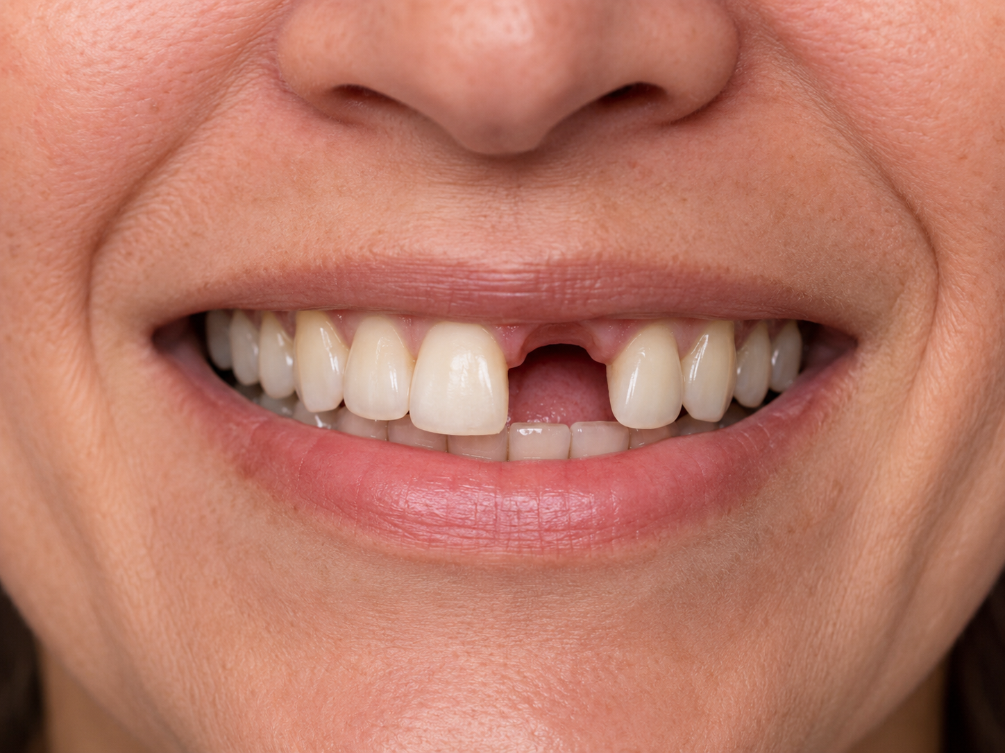 Before dental implant treatment showing missing teeth and visible gaps in an adult smile