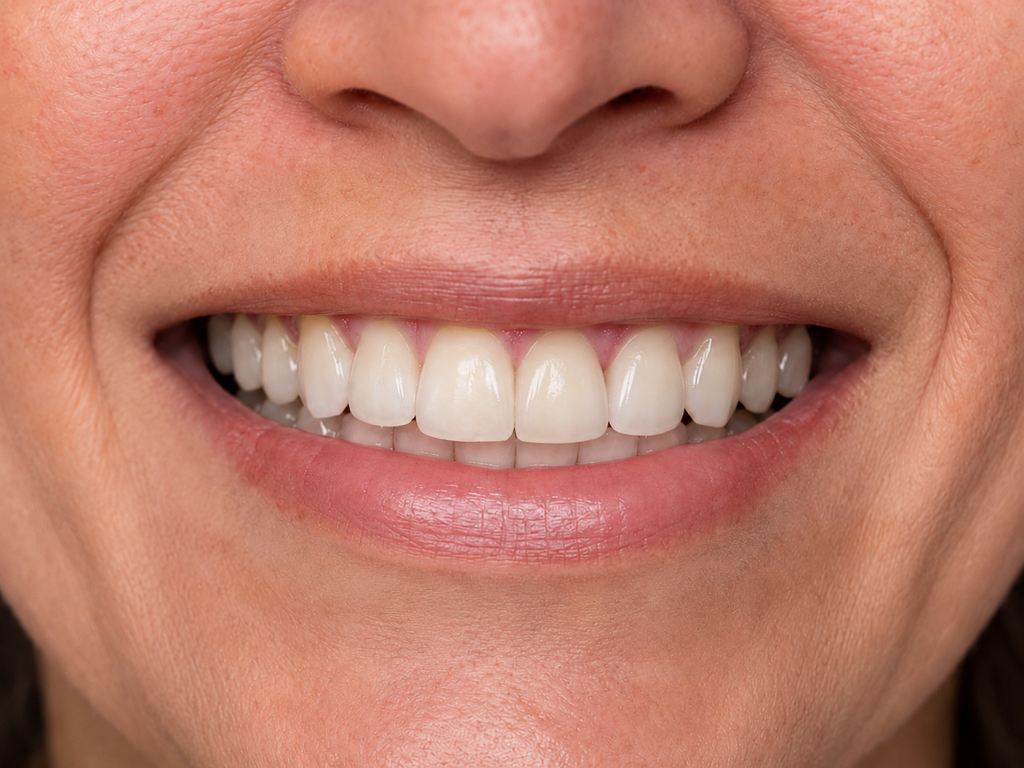 After dental implant restoration showing a natural-looking restored adult smile with implant crowns