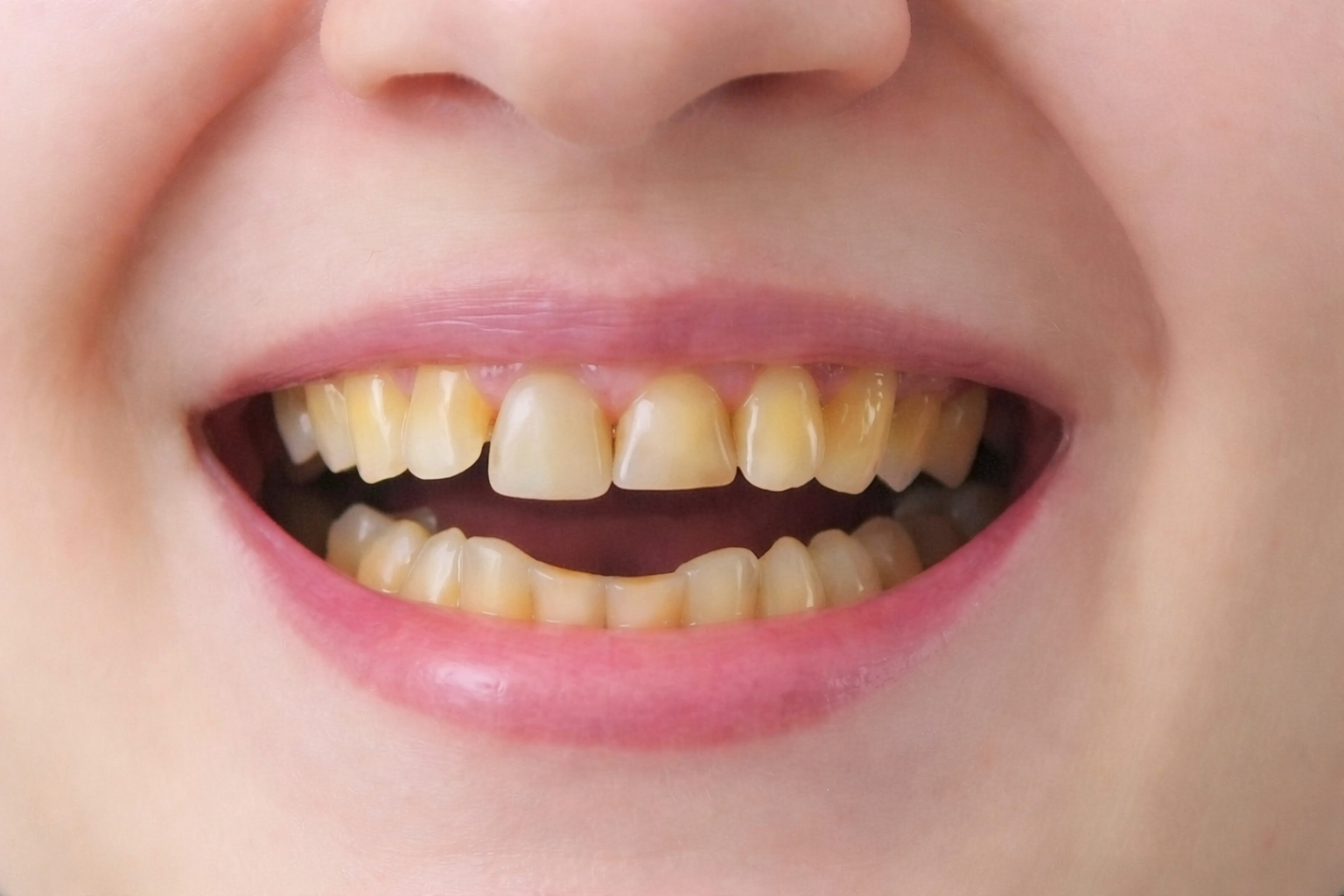 A close-up from a smile gallery features a smiling mouth with yellow-stained teeth and healthy pink lips.