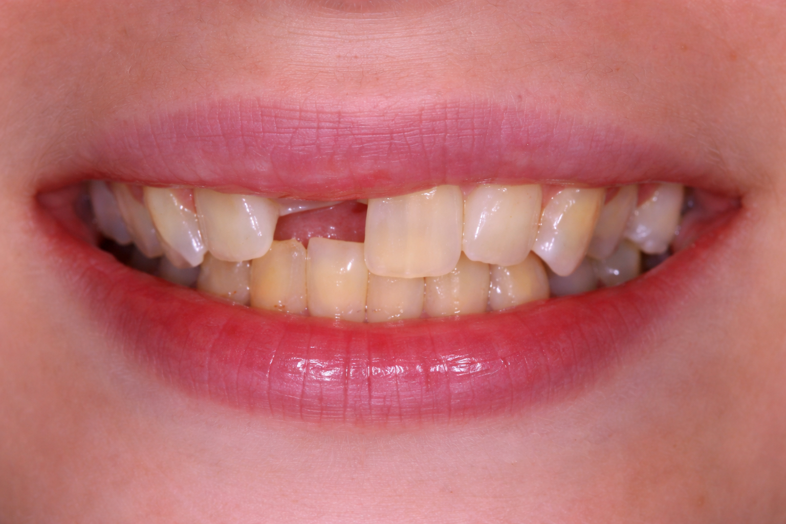 A close-up of a person’s partially open mouth, featured in our smile gallery, shows yellowed and misaligned upper and lower teeth with visible plaque and a gap between the top front teeth. Lips are slightly parted and natural in color.