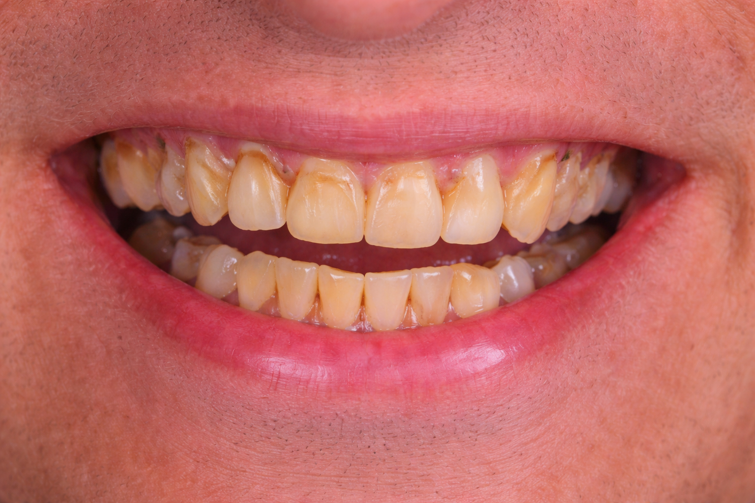 Dental Implant Smile Restoration before image
