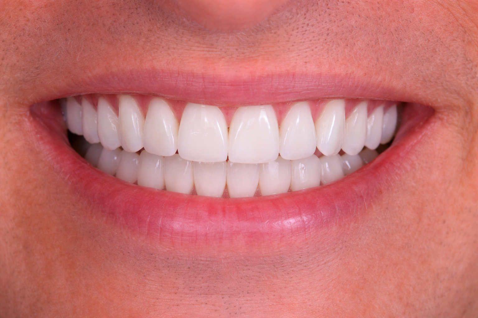 A close-up of a smiling mouth showing straight, white teeth and healthy pink lips and skin, perfect for showcasing in a smile gallery.