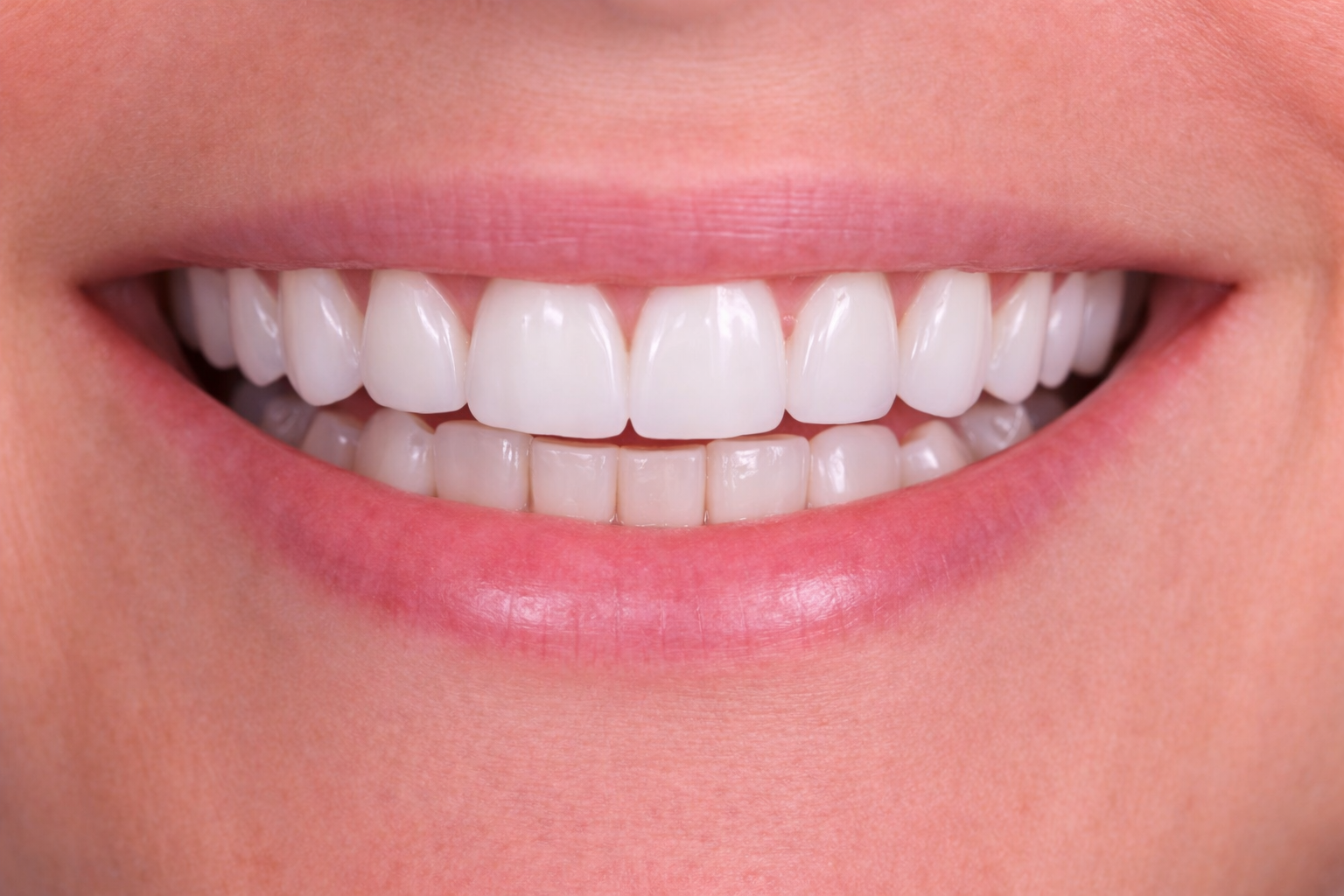 Orthodontic Smile Alignment after image