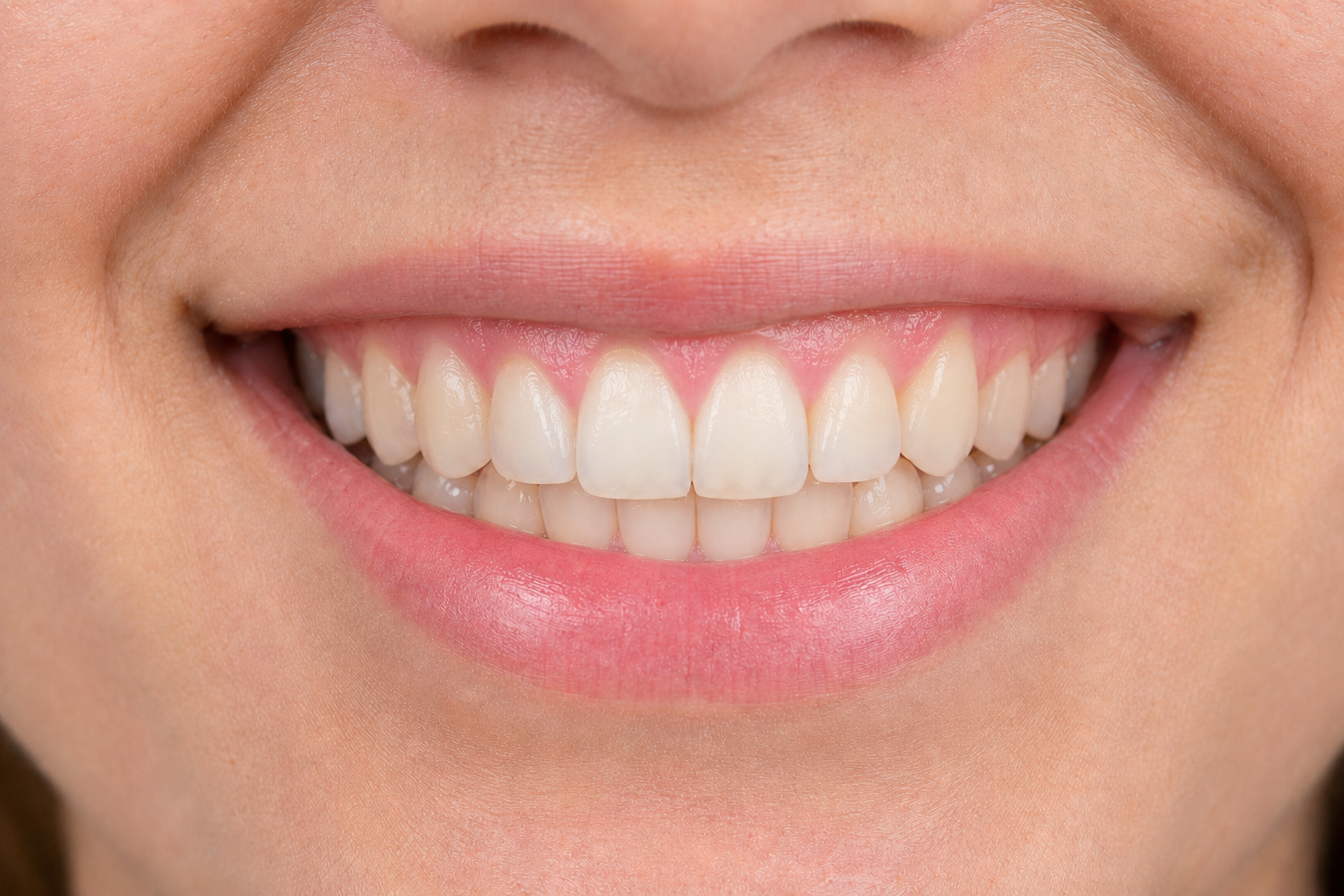 Porcelain Veneers Smile Makeover after image