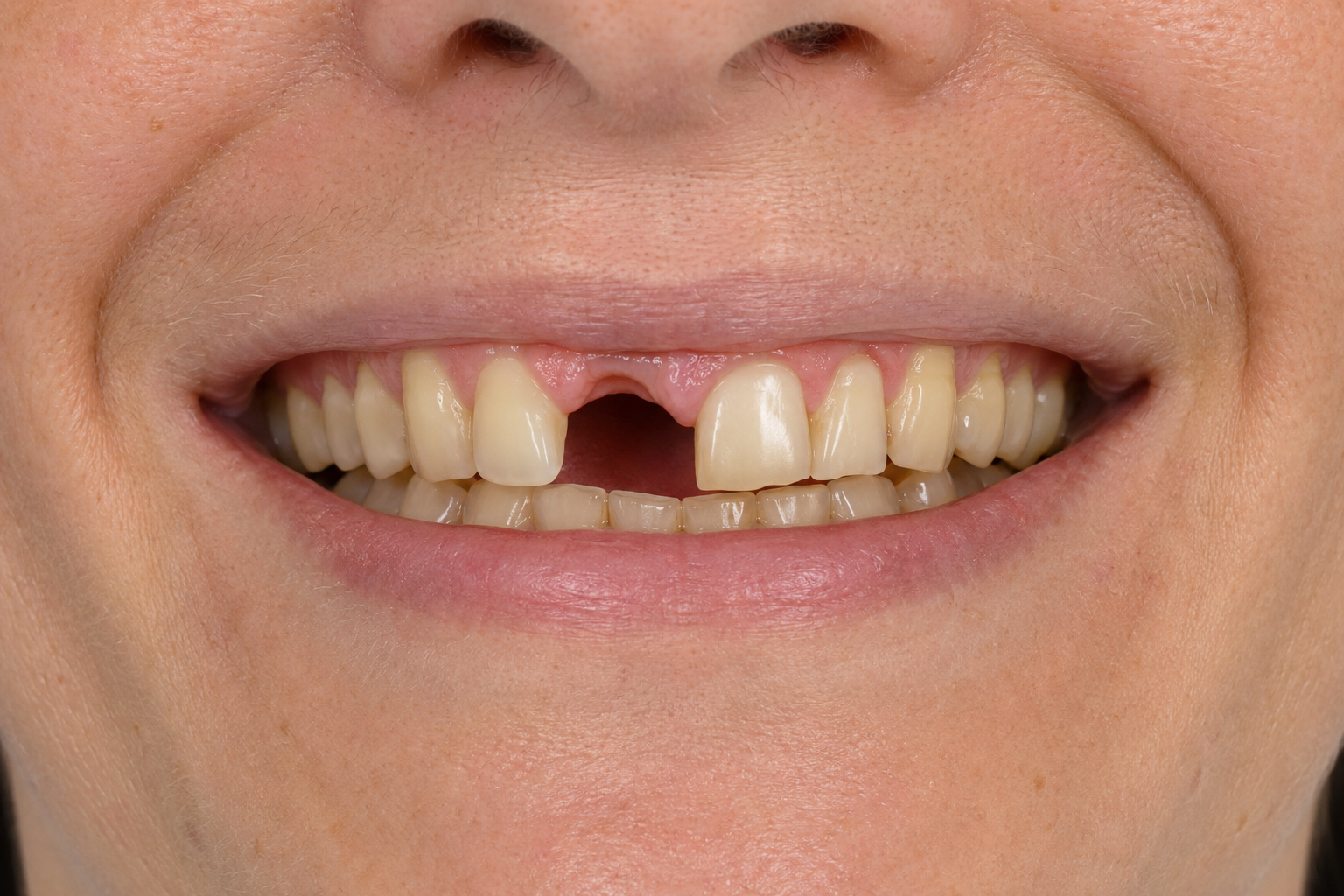 Full Smile Makeover before image