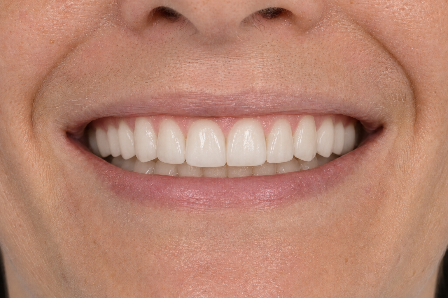 Full Smile Makeover after image